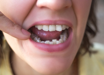 Closeup of crooked teeth