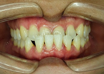 Closeup of someone’s underbite being worked on