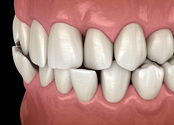 Rendering of crossbite with black background