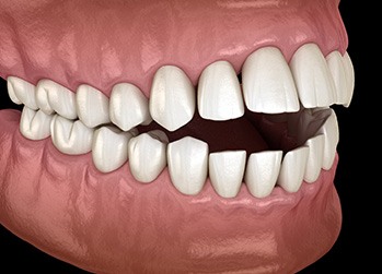 Rendering of open bite with black background