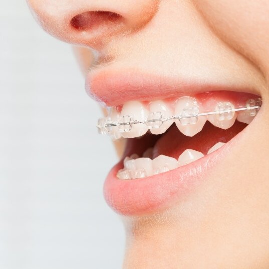 Closeup of smile with clear and ceramic braces