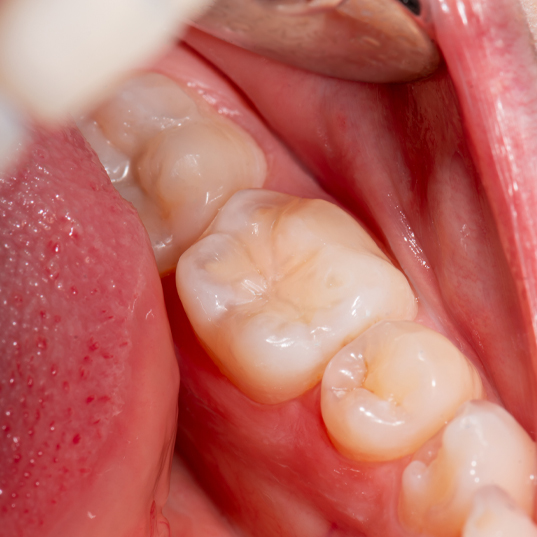 Closeup of child's teeth with dental sealants