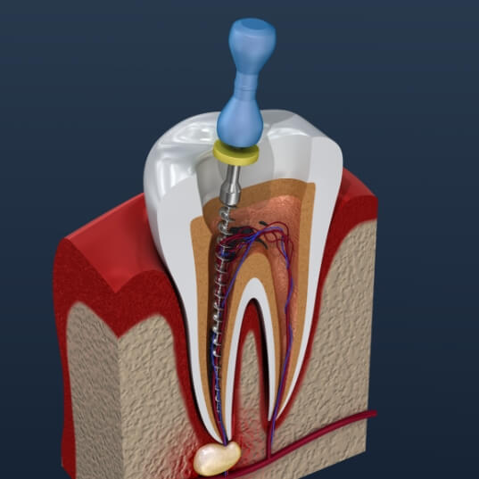 Animated inside of a tooth representing the pulp therapy process
