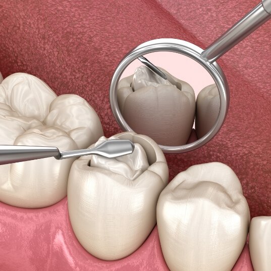 Animated smile during tooth colored filling placement