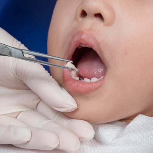 Child having tooth extracted