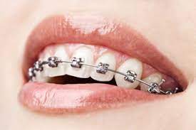 closeup of person with metal braces smiling 