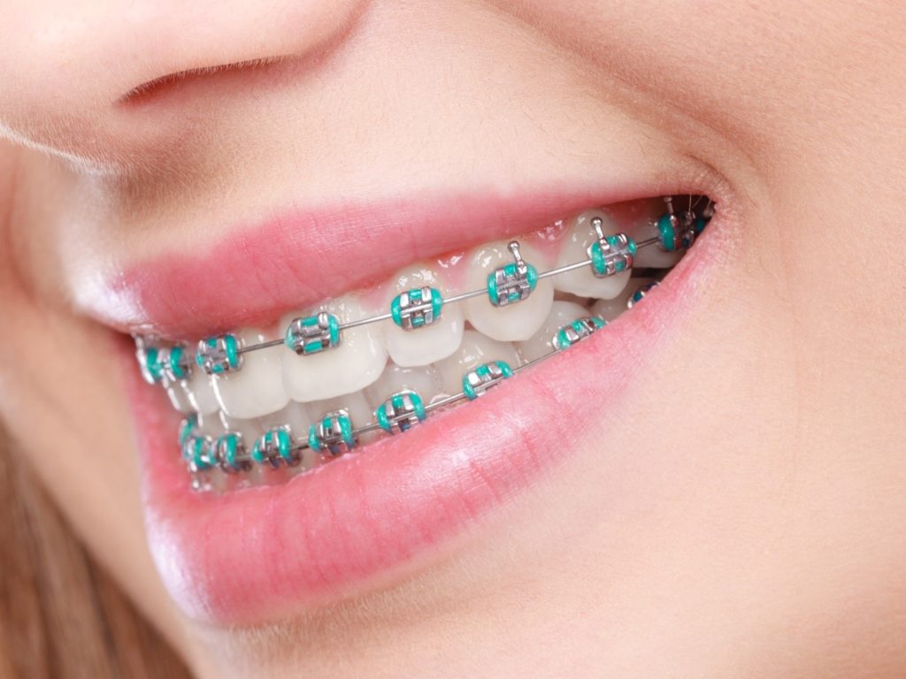 teen with metal braces