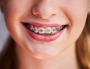 Picture of a child with braces