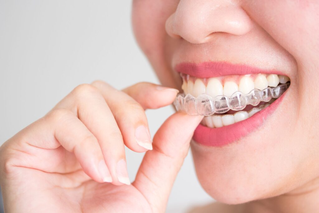 Nose-to-chin closeup of someone putting Invisalign over upper arch